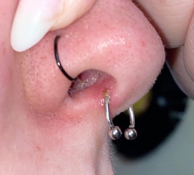 infected piercing